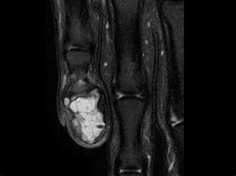 Finger With Giant Cell Tumor Philips Mr Body Map