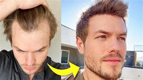 My Turkey Hair Transplant 4 Month Update Before After YouTube