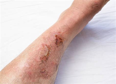 Best Scab Stock Photos Pictures And Royalty Free Images Istock