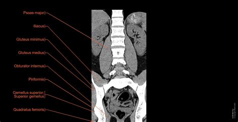 Lumbar Spine Normal Anatomy E Anatomy