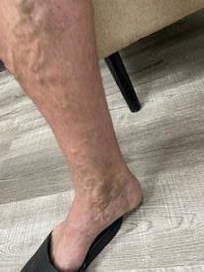 Vein Ablation Before And After Photos Vein And Aesthetics Center