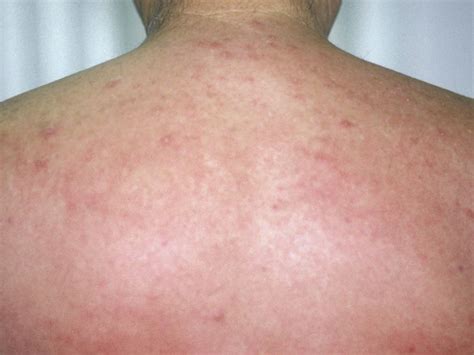 Childhood Rashes And Skin Conditions Photos Babycenter Canada