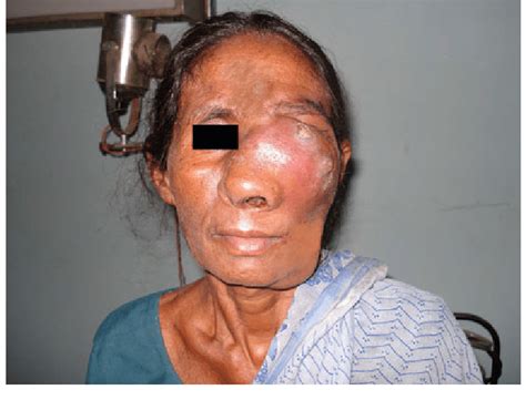 Swelling Over Left Side Of Face Involving Left Eye With Ulceration Of
