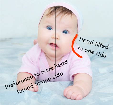 Torticollis Baby Exercises Learn Exercises For Your Baby With