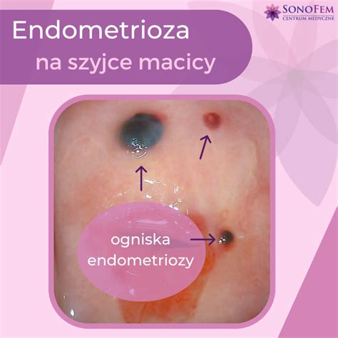 Laserowe Usuwanie Endometriozy Z Szyjki Macicy Sonofem Centrum Medyczne Warszawasonofem