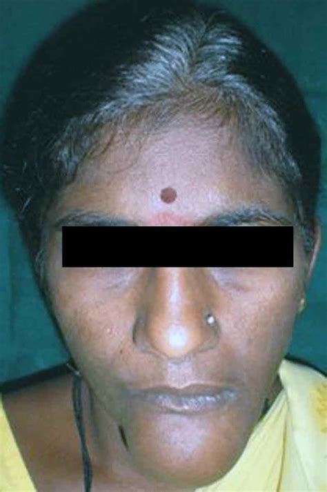 Clinical Photograph Showing Extra Oral Swelling In The Chin Region