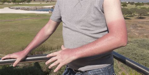 The Stages Of A Sunburn How A Sunburn Affects Your Skin