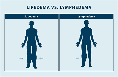 Differences Between Lipedema And Lymphedema Lymphedema Blog My Xxx Hot Girl