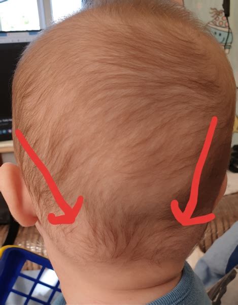 Two Large Soft Lumps Base Of Babys Head Mumsnet
