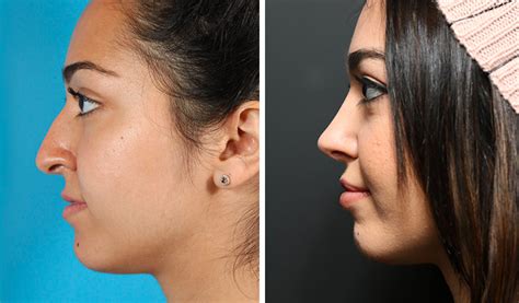 rhinoplasty toronto nose job cost ontario dr asaria