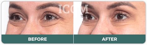 Anti Wrinkle Injections And Treatment Sydney Cbd And Campbelltown Iccm