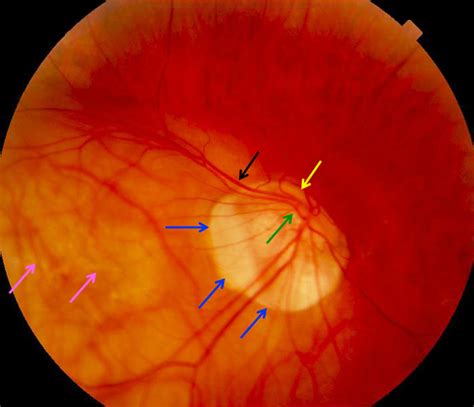 Staphyloma Retina