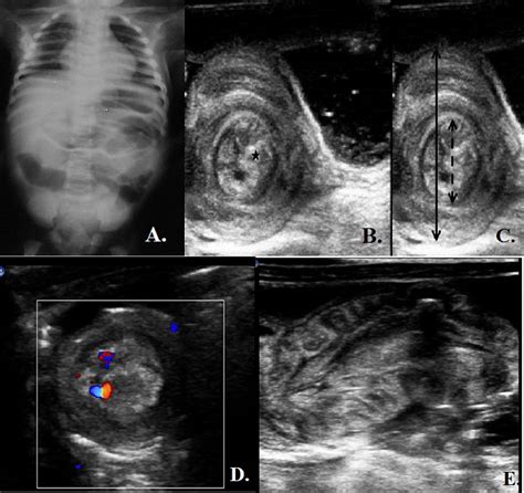 Evolving Concepts In Ultrasonography Of Pediatric Intussusceptions