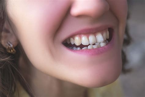 Crooked Teeth Causes And Treatment Options Ismile Specialists
