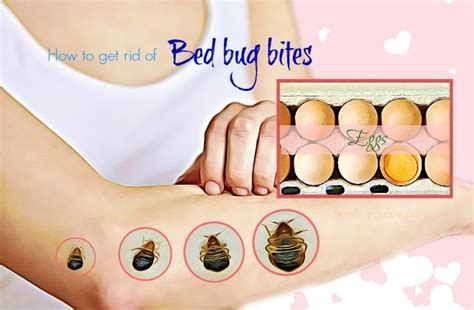 Top 37 Tips How To Get Rid Of Bed Bug Bites On Skin Fast