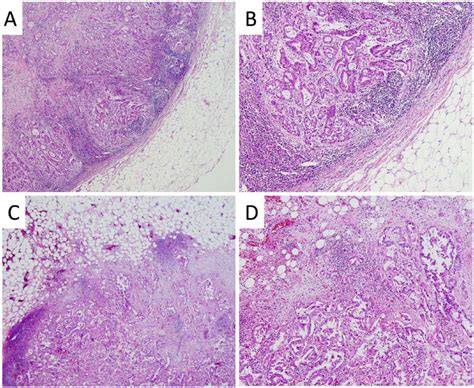 Prognostic Impact Of Extracapsular Lymph Node Invasion And