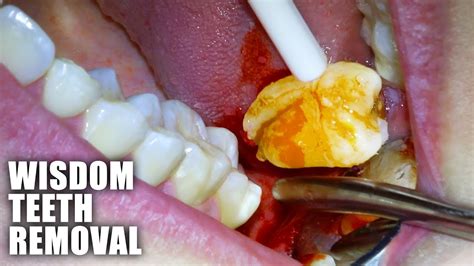 Full Wisdom Teeth Removal Procedure Emergency Extraction Of Impacted And Partially Erupted Molar