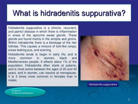 Hidradenitis Suppurativa Stage 3