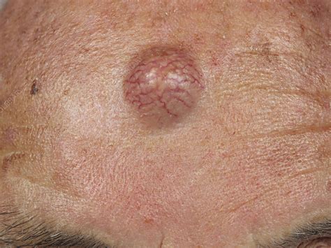 Sebaceous Cyst Stock Image C0521189 Science Photo Library