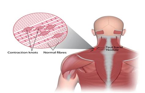 Understanding Myofascial Trigger Points In Human Body Esra Rehab