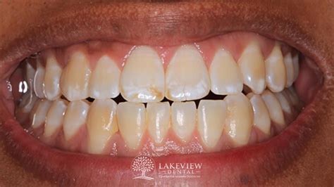 Bleach And Remove Brown Spot Stain Front Tooth Lakeview Dental