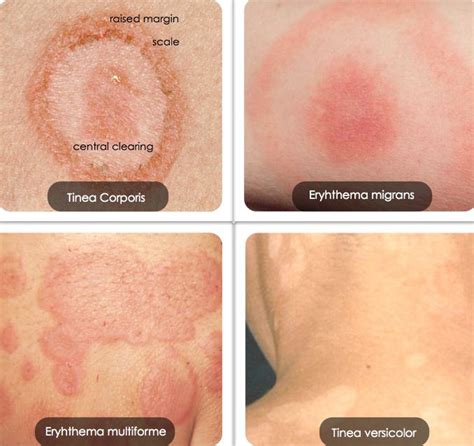 Nummular Eczema Vs Ringworm Pictures