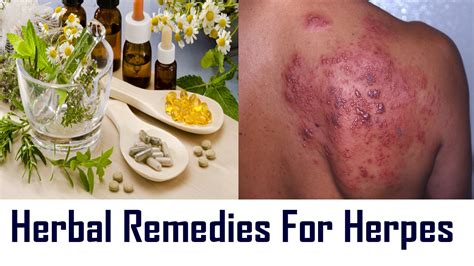 herbal remedies for herpes top natural herbal remedies for treatment of herpes youtube
