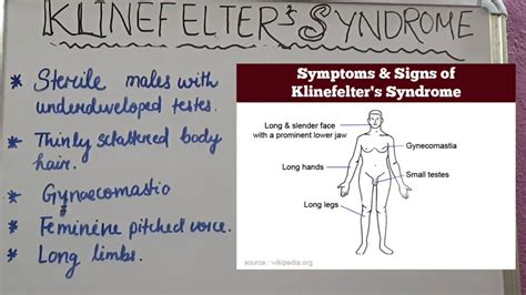Klinefelter Syndromexxy Signs Symptoms Youtube