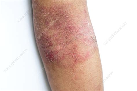 Eczema Of The Elbow Stock Image C0238964 Science Photo Library