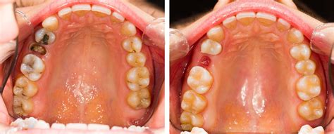 How Long Does It Take Gums To Heal After A Tooth Extraction