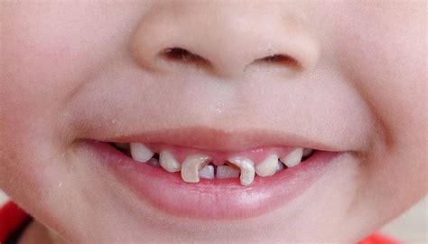 Itulah pandangan orang alim tentang mimpi gigi patah. 9 Arti Mimpi Gigi Berlubang Menurut Primbon Jawa - ramalan ...