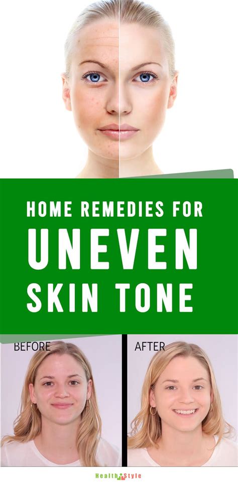 Uneven Skin Tone Get Rids With Natural Remedies Improve Skin