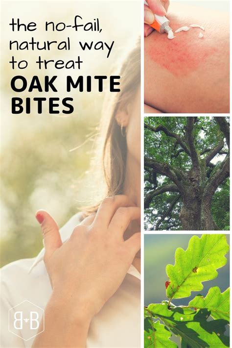 56 Best Of How To Treat Mite Bites On Skin Insectza