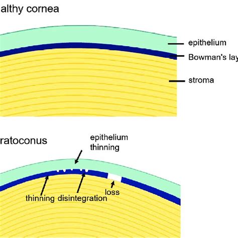 In Healthy Corneas The Epithelium And Bowman S Layer Are Smooth And
