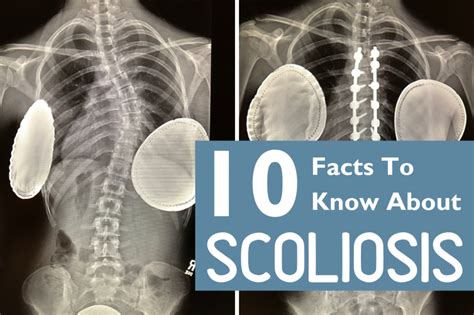 Ten Facts To Know About Scoliosis News Orthopedic Blog Orthocarolina