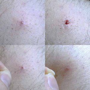 Ingrown Hair Turned Into Hard Lump Under Skin Learn From Doctor