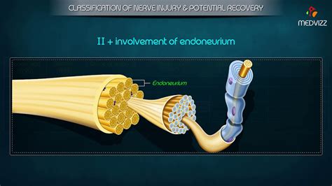 The type of nerve injury will determine the type of treatment that will be needed. Classification of Peripheral Nerve Injury - Seddon's ...