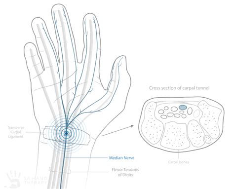Carpal Tunnel Syndrome Sa Hand Therapy