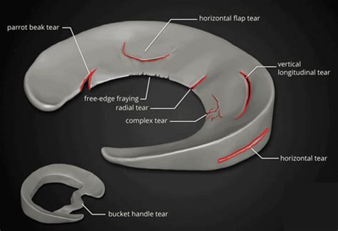 The Complete Guide To A Meniscus Tear Kinetic Labs Toronto