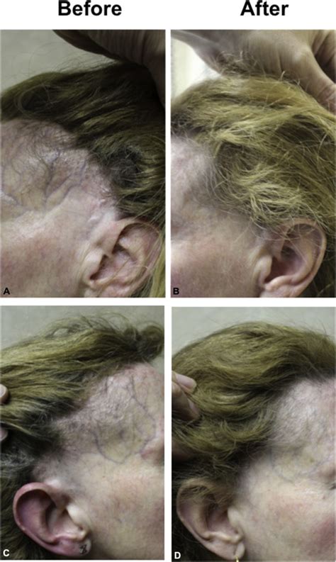 If hair grows back, it may not have its usual colour at first and look grey or white for a while. Finasteride-mediated hair regrowth and reversal of atrophy ...