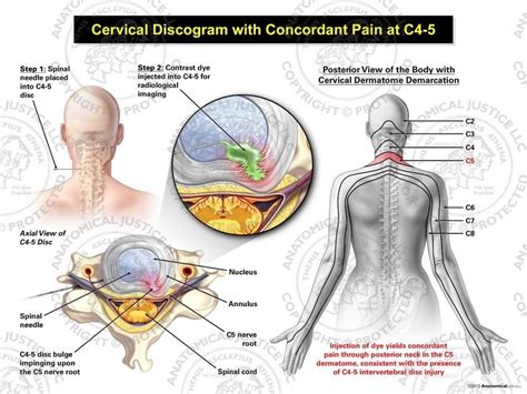 Female Left Cervical Discogram With Concordant Pain At C4 5