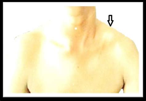 Photograph Depicting Swelling At The Left Clavicular Region Radiograph