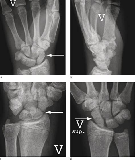Examination And Treatment Of Scaphoid Fractures And Pseudarthrosis