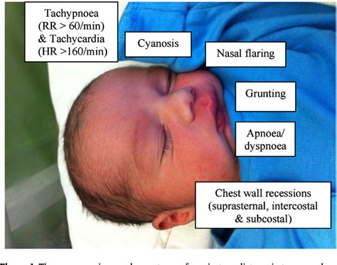 Immunocompromised patients with acute respiratory distress syndrome: Figure 1 from Respiratory distress of the term newborn ...