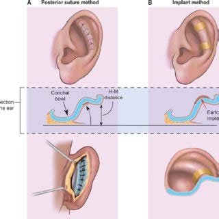 Permanent Cartilage Liberal Dictionary