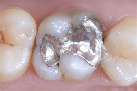 One Large And One Small Direct Facing Restorations