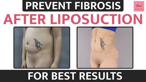 What Is Fibrosis Fibrosis After Liposuction How To Prevent Fibrosis Treatments Of