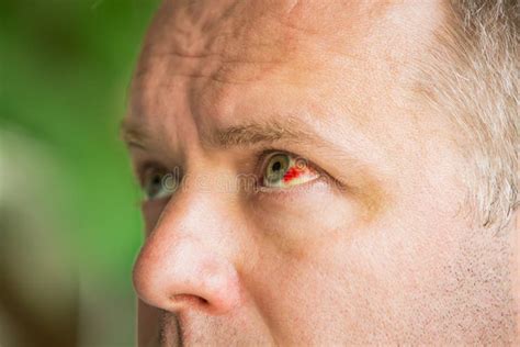 Close Up Of Man With Broken Blood Vessel In Eye Stock Photo Image Of