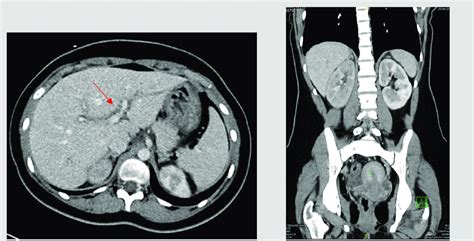 Ct Scan Of The Abdomen Showing Intrahepatic Periportal Thickening And