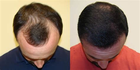 How To Reverse Balding In One Maxharvest™ Procedure Dr Brett Bolton